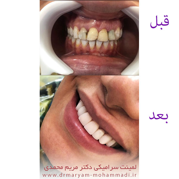 لمینت دندان در کرج 